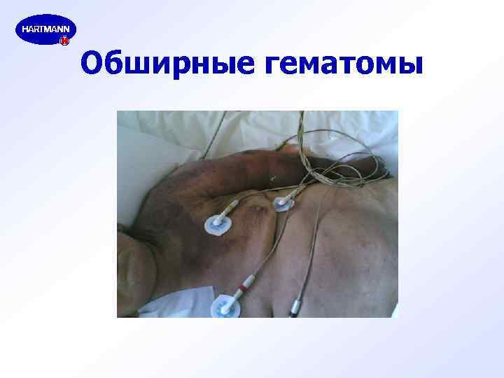 Обширные гематомы 