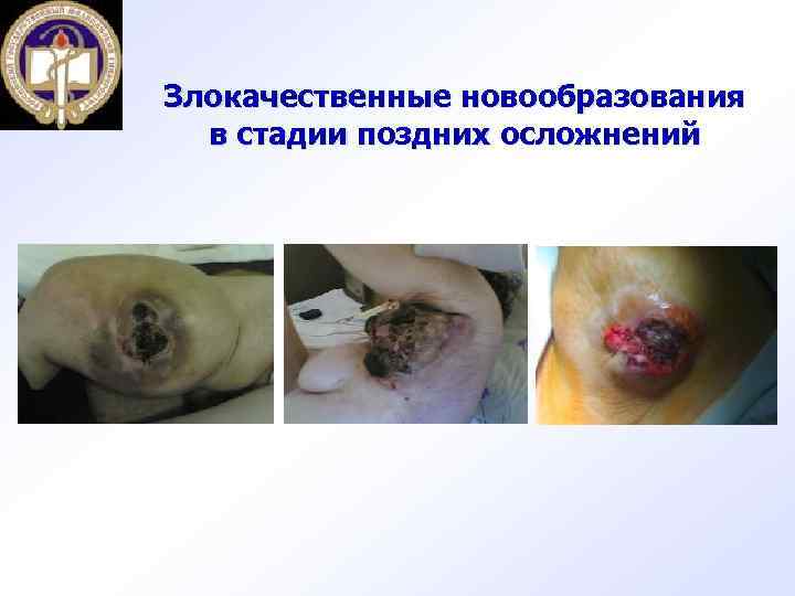 Злокачественные новообразования в стадии поздних осложнений 