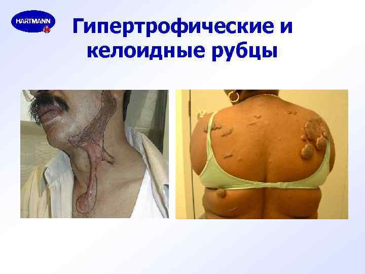 Гипертрофические и келоидные рубцы 