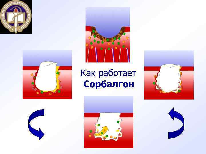 Как работает Сорбалгон 
