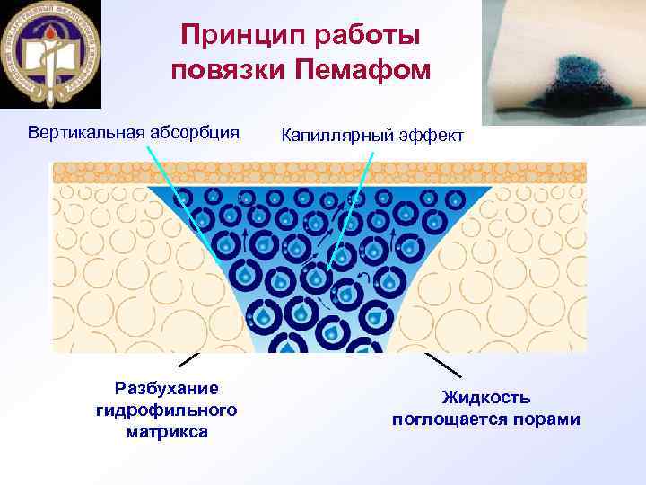 Принцип работы повязки Пемафом Вертикальная абсорбция Разбухание гидрофильного матрикса Капиллярный эффект Жидкость поглощается порами