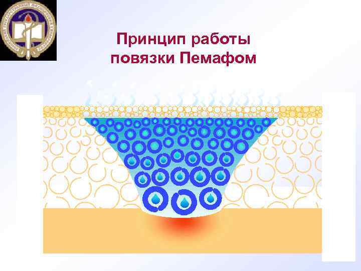 Принцип работы повязки Пемафом 