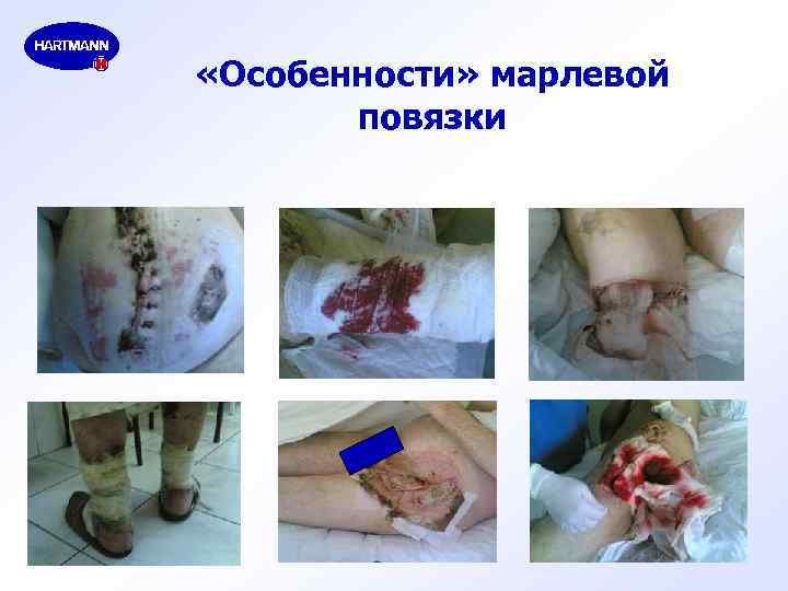  «Особенности» марлевой повязки 