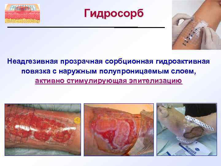 Гидросорб Неадгезивная прозрачная сорбционная гидроактивная повязка с наружным полупроницаемым слоем, активно стимулирующая эпителизацию 