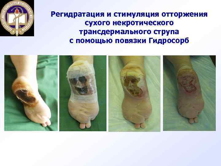 Регидратация и стимуляция отторжения сухого некротического трансдермального струпа с помощью повязки Гидросорб 