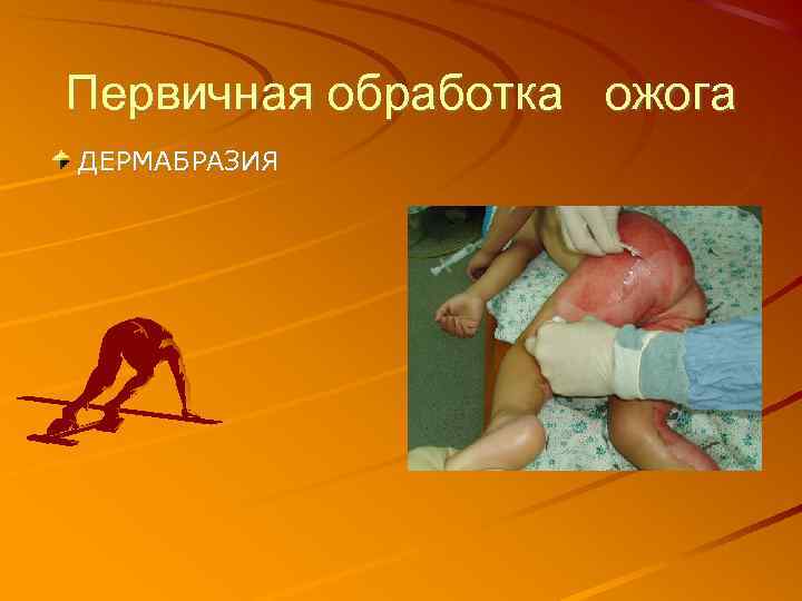 Первичная обработка ожога ДЕРМАБРАЗИЯ 