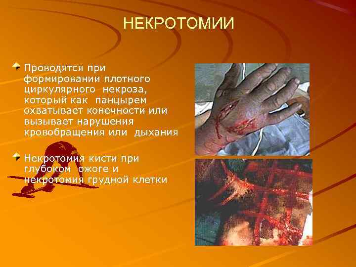 НЕКРОТОМИИ Проводятся при формировании плотного циркулярного некроза, который как панцырем охватывает конечности или вызывает