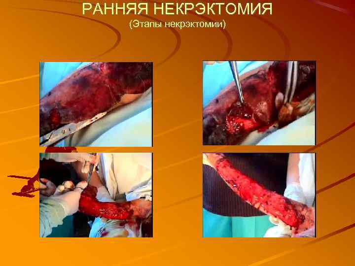 РАННЯЯ НЕКРЭКТОМИЯ (Этапы некрэктомии) 