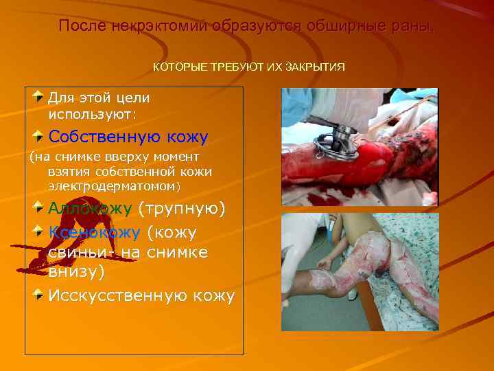 После некрэктомий образуются обширные раны, КОТОРЫЕ ТРЕБУЮТ ИХ ЗАКРЫТИЯ Для этой цели используют: Собственную