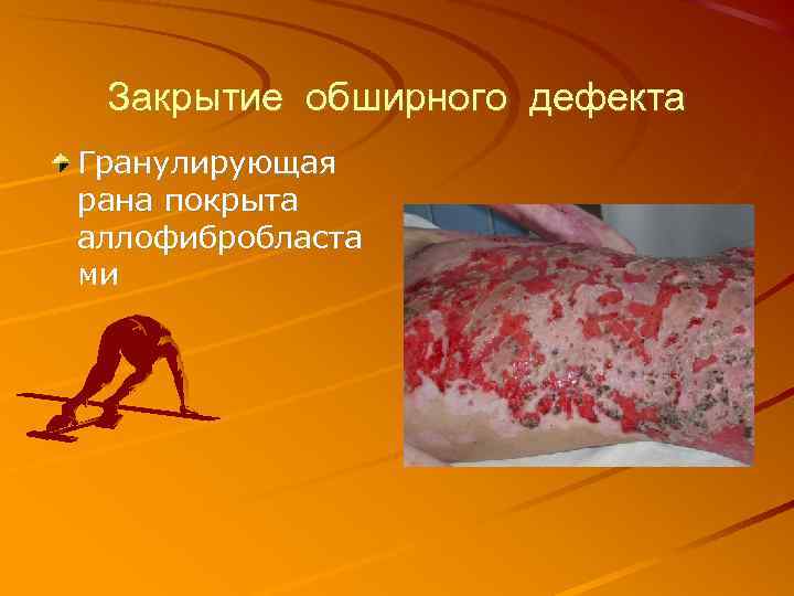 Закрытие обширного дефекта Гранулирующая рана покрыта аллофибробласта ми 