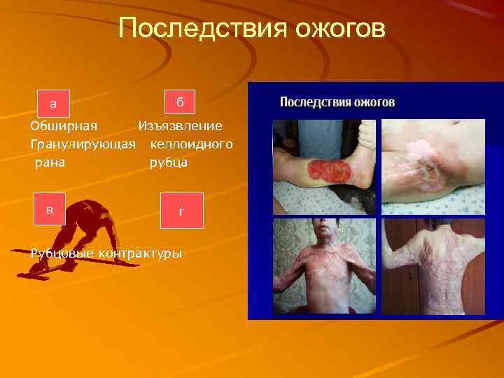 Последствия ожогов а б Обширная Изъязвление Гранулирующая келлоидного рана рубца в г Рубцовые контрактуры