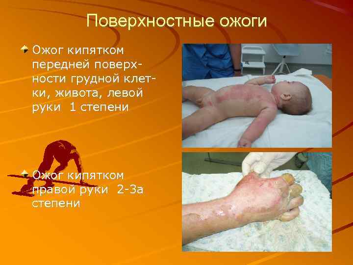 Поверхностные ожоги Ожог кипятком передней поверхности грудной клетки, живота, левой руки 1 степени Ожог