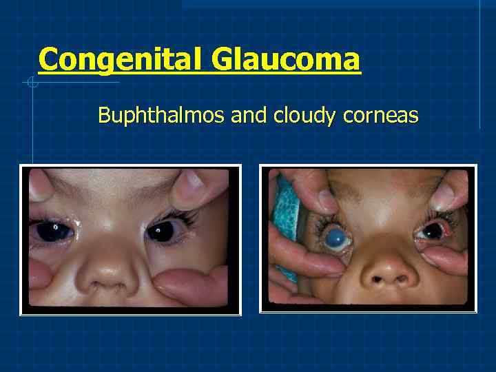 Congenital Glaucoma Buphthalmos and cloudy corneas 
