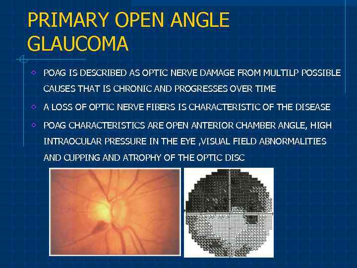 PRIMARY OPEN ANGLE GLAUCOMA POAG IS DESCRIBED AS OPTIC NERVE DAMAGE FROM MULTILP POSSIBLE
