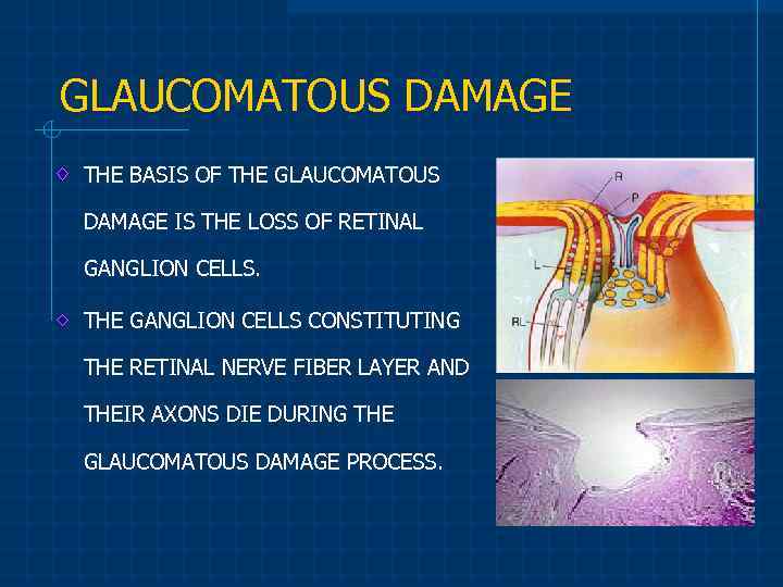 GLAUCOMATOUS DAMAGE THE BASIS OF THE GLAUCOMATOUS DAMAGE IS THE LOSS OF RETINAL GANGLION
