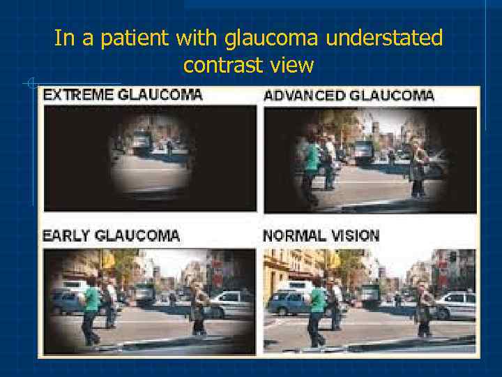 In a patient with glaucoma understated contrast view 