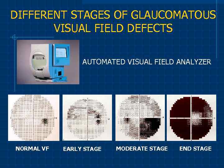 DIFFERENT STAGES OF GLAUCOMATOUS VISUAL FIELD DEFECTS AUTOMATED VISUAL FIELD ANALYZER NORMAL VF EARLY