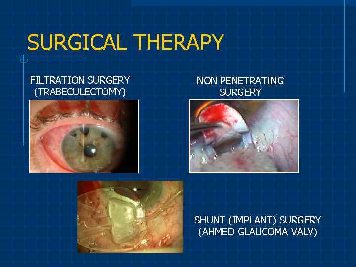 SURGICAL THERAPY FILTRATION SURGERY (TRABECULECTOMY) NON PENETRATING SURGERY SHUNT (IMPLANT) SURGERY (AHMED GLAUCOMA VALV)