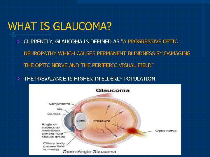WHAT IS GLAUCOMA? CURRENTLY, GLAUCOMA IS DEFINED AS “A PROGRESSIVE OPTIC NEUROPATHY WHICH CAUSES