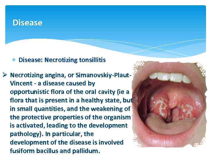 Disease Disease: Necrotizing tonsillitis Ø Necrotizing angina, or Simanovskiy-Plaut. Vincent - a disease caused