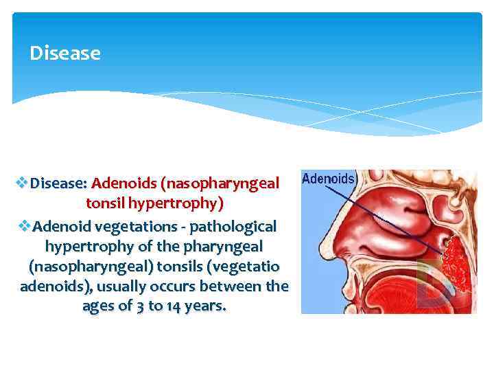 Disease v. Disease: Adenoids (nasopharyngeal tonsil hypertrophy) v. Adenoid vegetations - pathological hypertrophy of