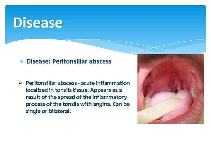 Disease Disease: Peritonsillar abscess Ø Peritonsillar abscess - acute inflammation localized in tonsils tissue.