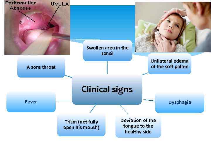 Swollen area in the tonsil Unilateral edema of the soft palate A sore throat
