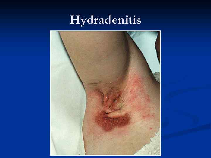 Hydradenitis 