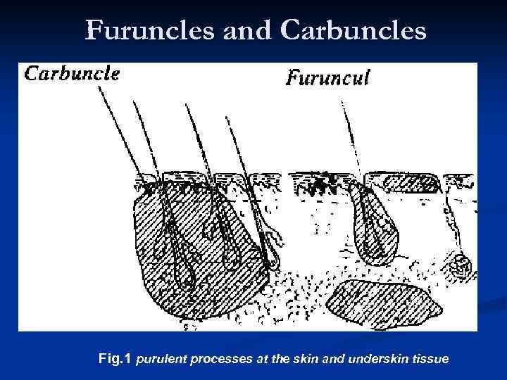 Furuncles and Carbuncles Fig. 1 purulent processes at the skin and underskin tissue 