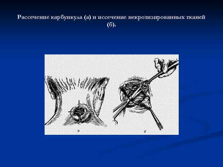 Рассечение карбункула (а) и иссечение некротизированных тканей (б). 