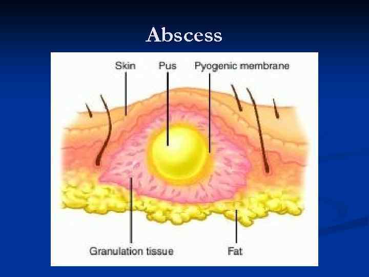 Abscess 