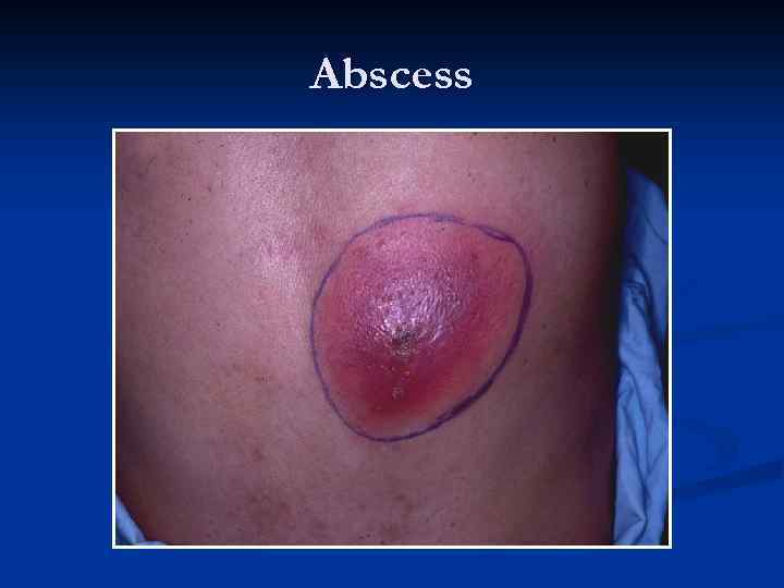 Abscess 