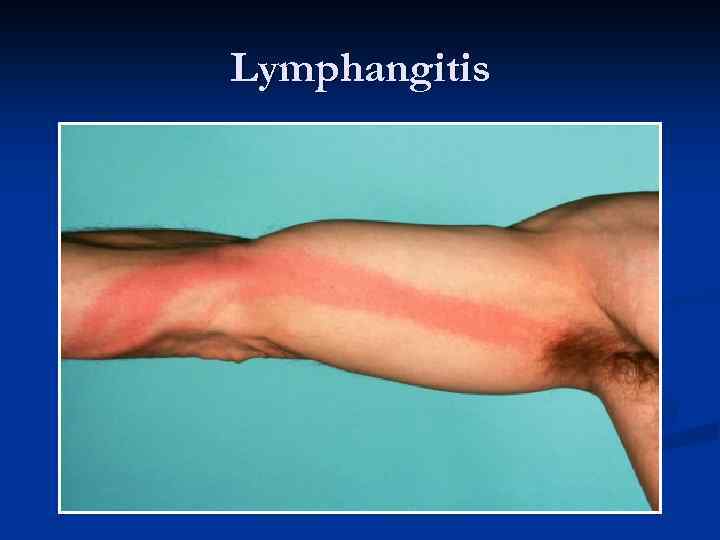 Lymphangitis 