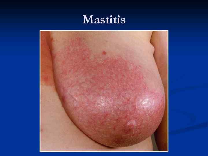 Mastitis 