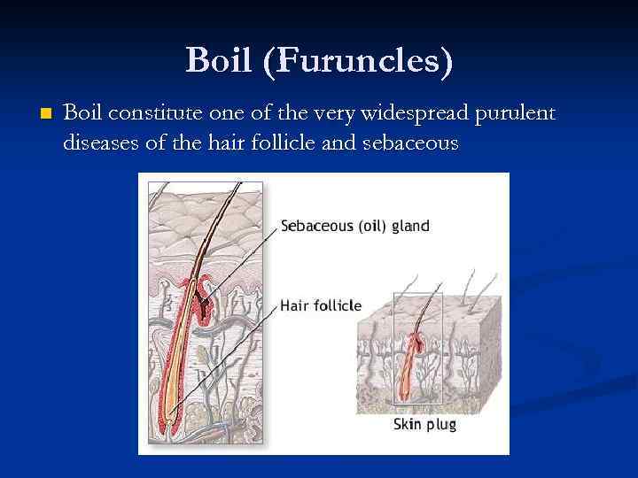 Boil (Furuncles) n Boil constitute one of the very widespread purulent diseases of the