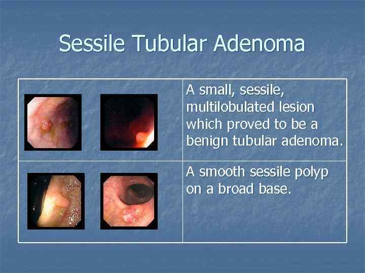 Sessile Tubular Adenoma A small, sessile, multilobulated lesion which proved to be a benign