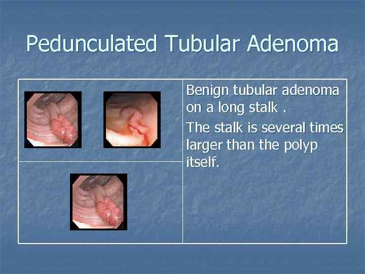 Pedunculated Tubular Adenoma Benign tubular adenoma on a long stalk. The stalk is several