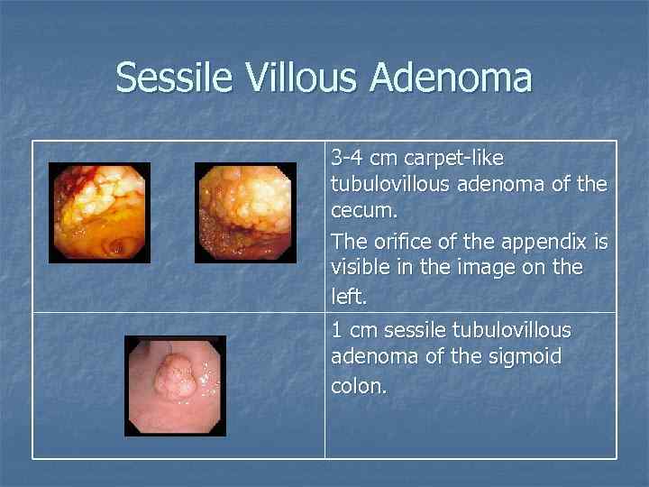 Sessile Villous Adenoma 3 -4 cm carpet-like tubulovillous adenoma of the cecum. The orifice
