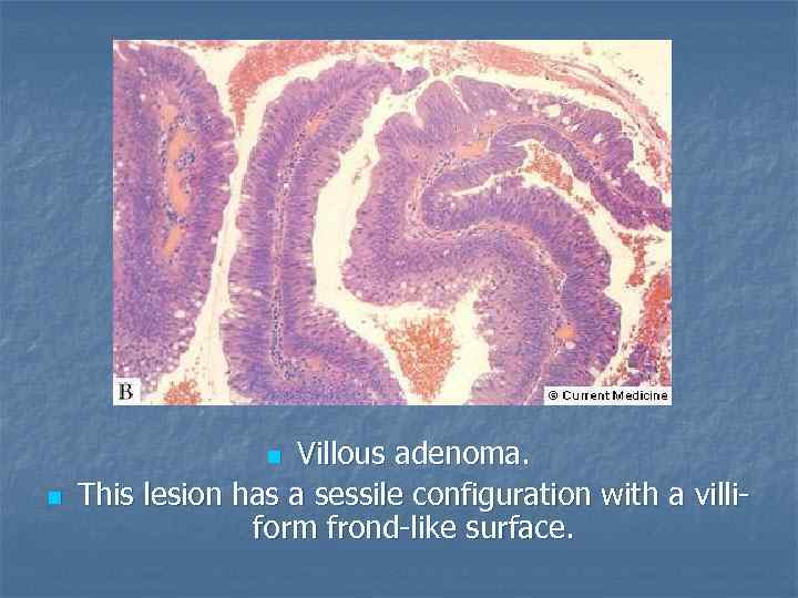 Villous adenoma. This lesion has a sessile configuration with a villiform frond-like surface. n