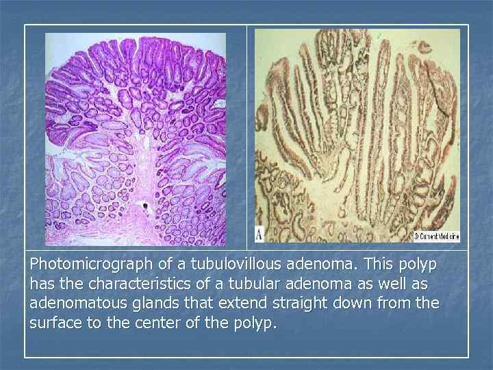 Photomicrograph of a tubulovillous adenoma. This polyp has the characteristics of a tubular adenoma