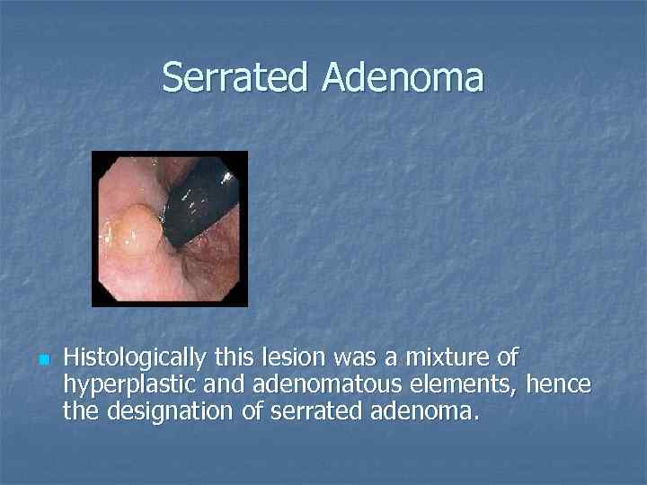 Serrated Adenoma n Histologically this lesion was a mixture of hyperplastic and adenomatous elements,