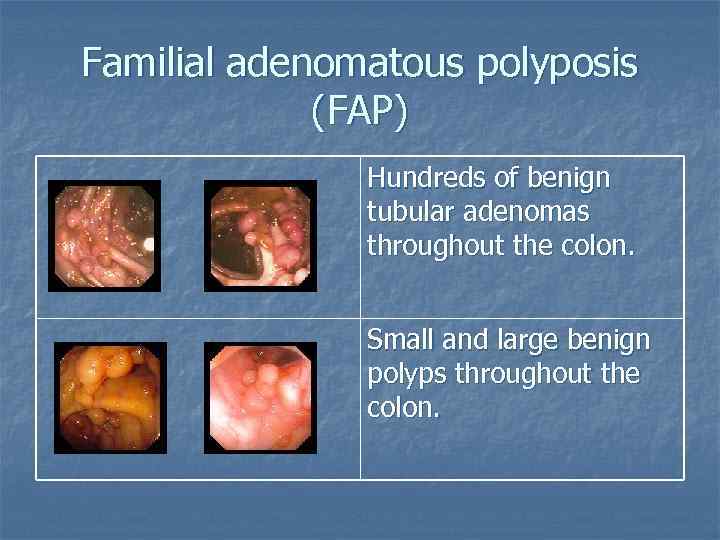 Familial adenomatous polyposis (FAP) Hundreds of benign tubular adenomas throughout the colon. Small and