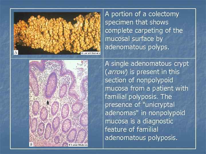 A portion of a colectomy specimen that shows complete carpeting of the mucosal surface