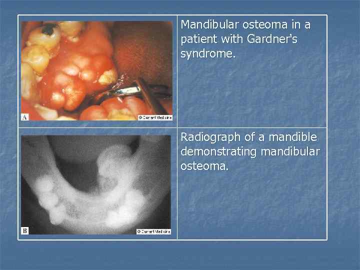 Mandibular osteoma in a patient with Gardner's syndrome. Radiograph of a mandible demonstrating mandibular
