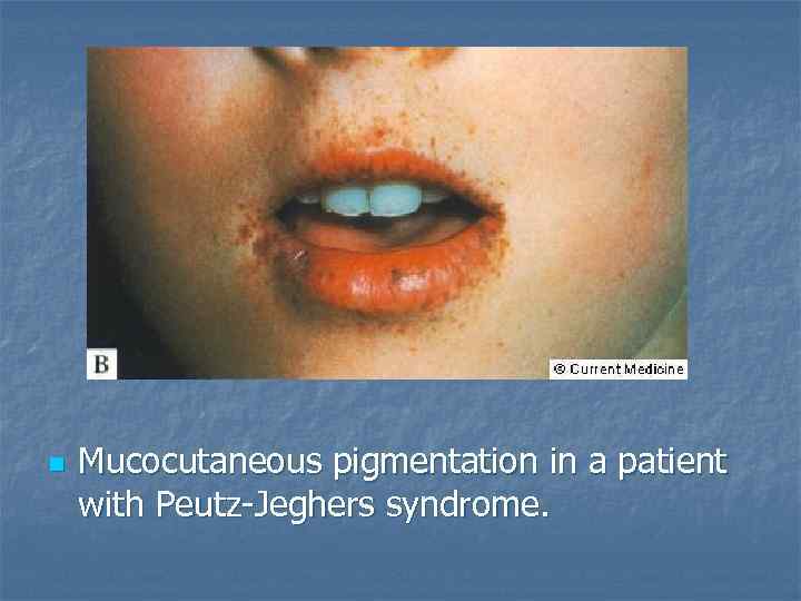 n Mucocutaneous pigmentation in a patient with Peutz-Jeghers syndrome. 
