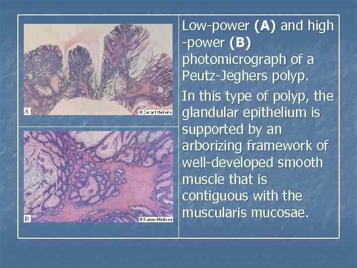 Low-power (A) and high -power (B) photomicrograph of a Peutz-Jeghers polyp. In this type