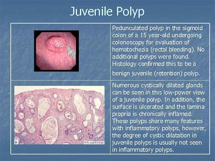 Juvenile Polyp Pedunculated polyp in the sigmoid colon of a 15 year-old undergoing colonoscopy