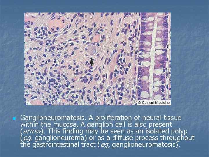 n Ganglioneuromatosis. A proliferation of neural tissue within the mucosa. A ganglion cell is