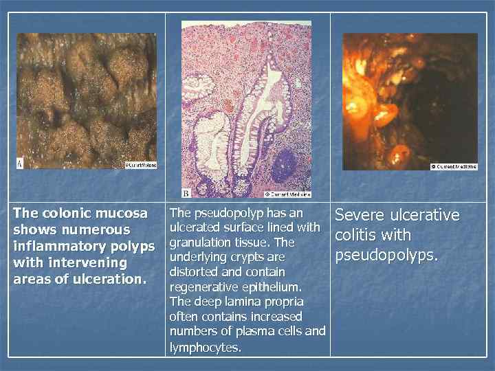 The colonic mucosa shows numerous inflammatory polyps with intervening areas of ulceration. The pseudopolyp