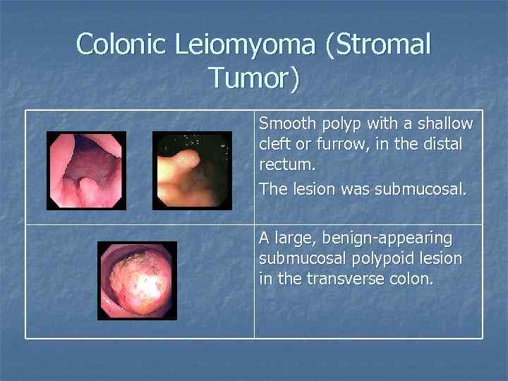 Colonic Leiomyoma (Stromal Tumor) Smooth polyp with a shallow cleft or furrow, in the